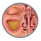 facts and stats about balloon sinulplasty